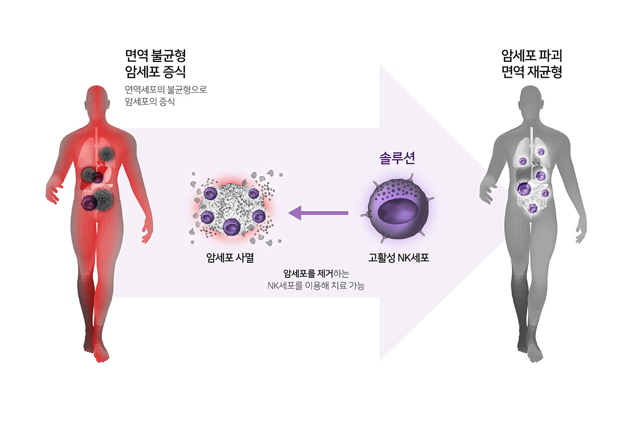 암세포를 제거하는 NK세포를 이용해 치료 가능